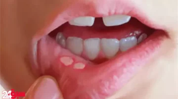 الهربس بين الرضع خطر يهدد المواليد.. إليك أهم أعراضه وطرق الوقاية منه